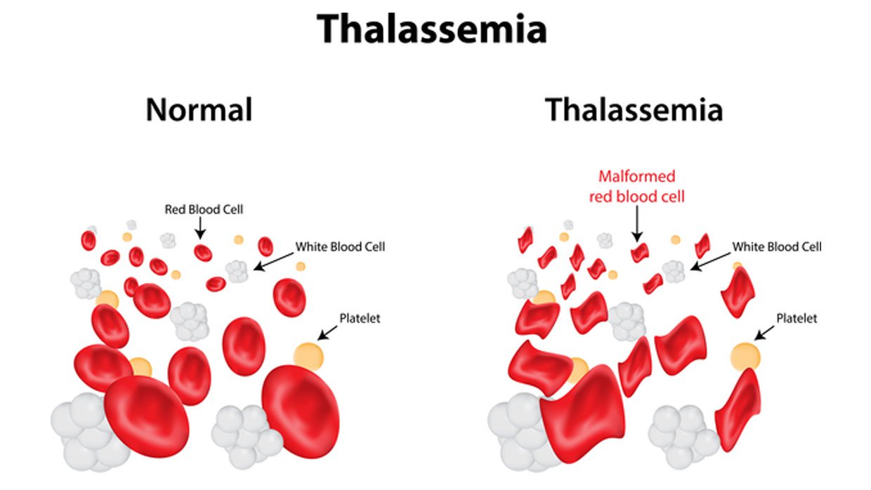 Bệnh Thalassemia di truyền thế nào?