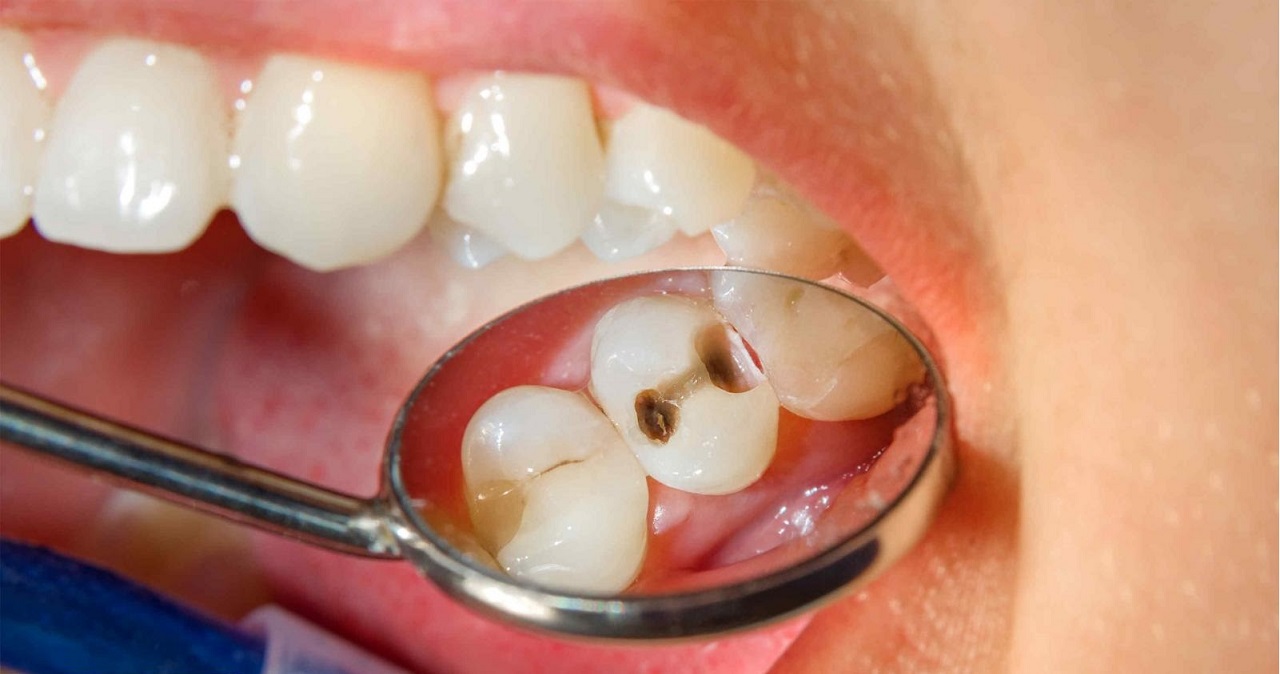 Phòng ngừa sâu răng cho trẻ đúng cách